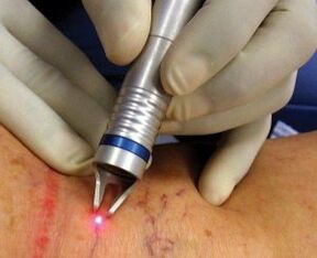 Jak se provádí laserové ošetření křečových žil