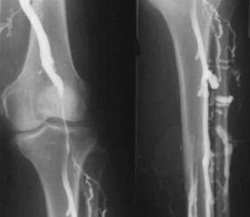 Možnosti diagnostiky křečových žil končetin