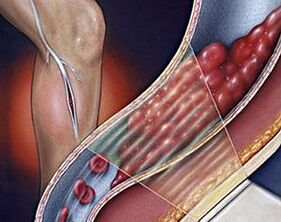 křečové žíly hlubokých žil dolních končetin